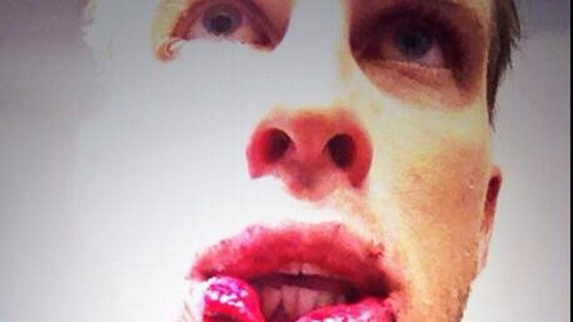 Pro D2 - LOU : Lachie Munro se fait couper la lèvre en deux