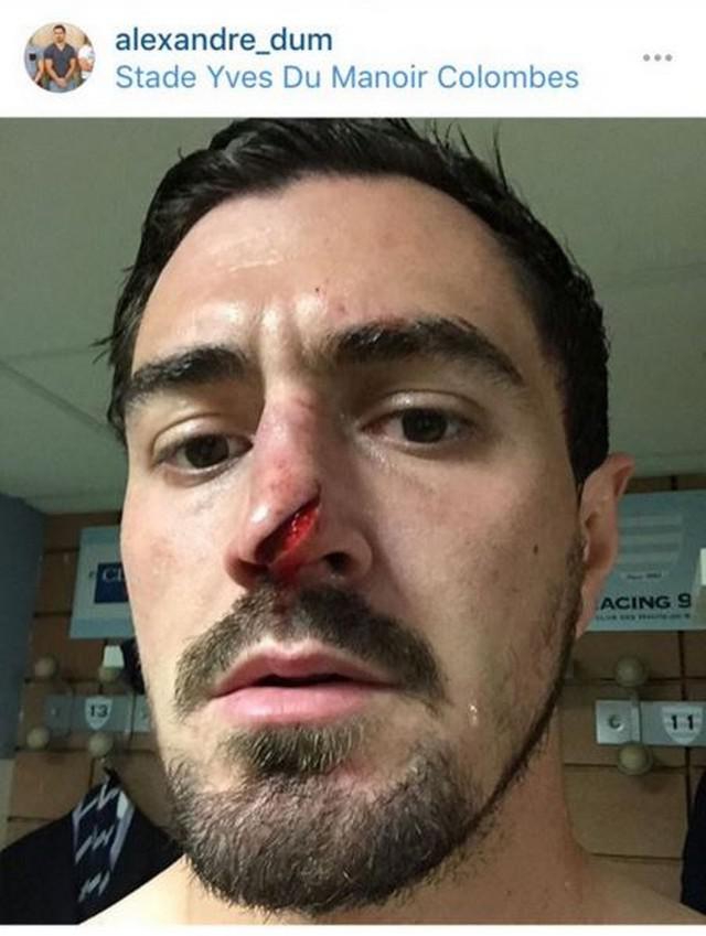 VIDEO. Champions Cup - Racing 92 : la très vilaine blessure au nez d'Alexandre Dumoulin